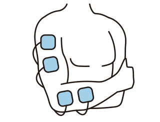 General TENS electrode pad placement on the upper arm and forearm